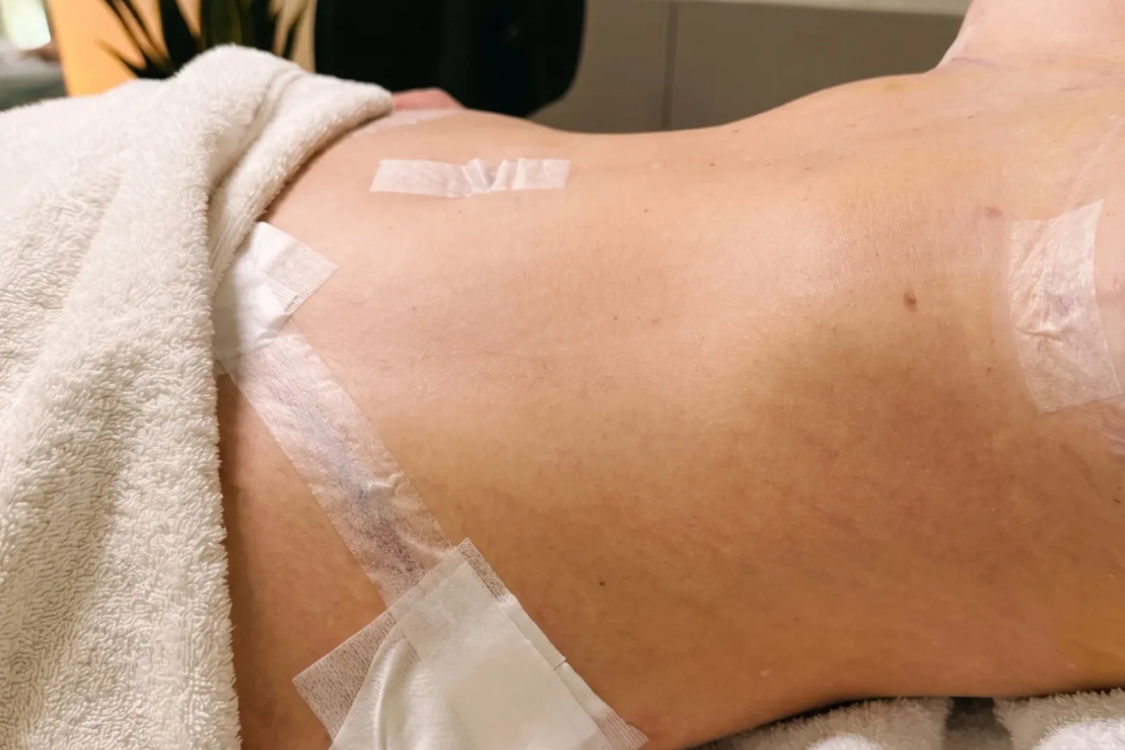 Abdomen en phase post-opératoire précoce, pansements et drain visibles, ambiance cabinet.