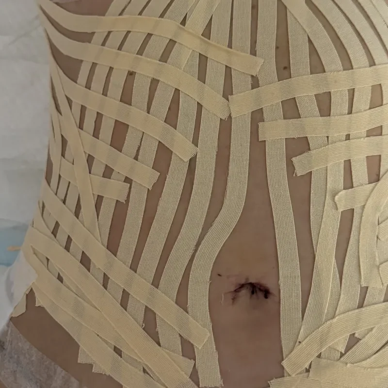 Taping lymphatique en place sur abdomen post-opératoire.