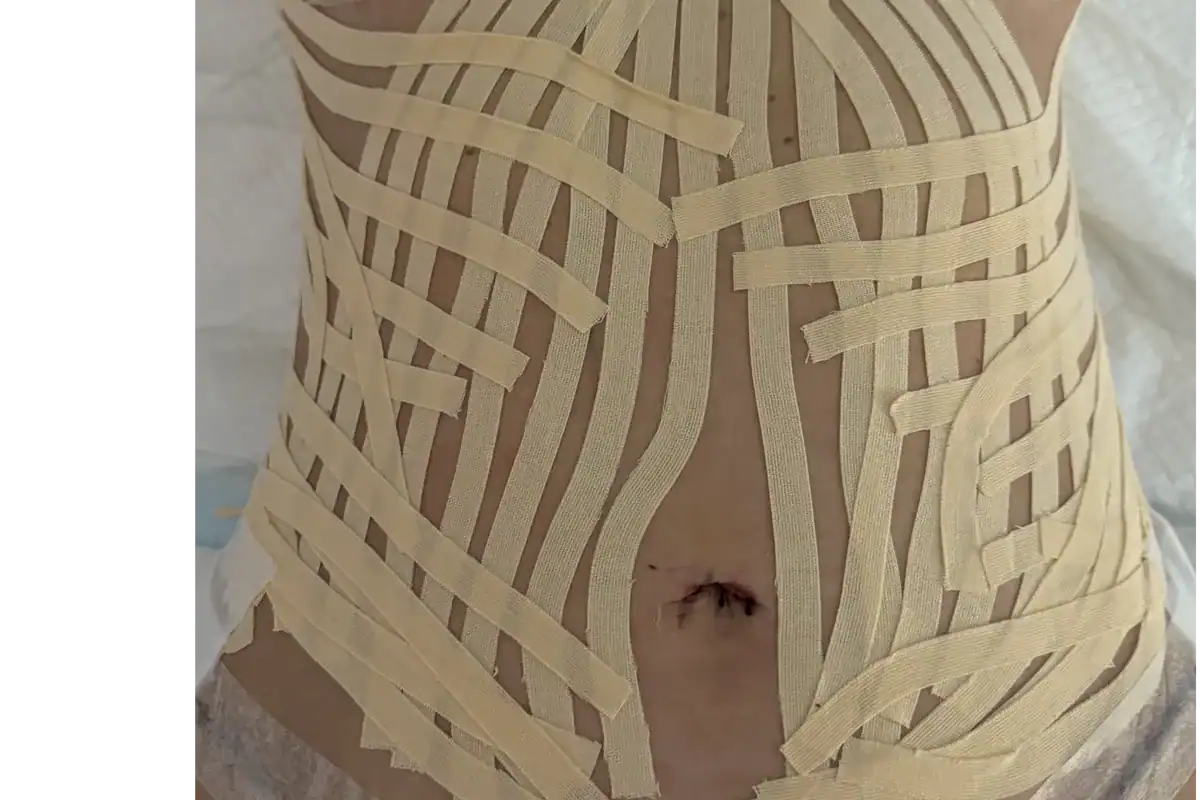 Taping lymphatique en place sur abdomen post-opératoire.